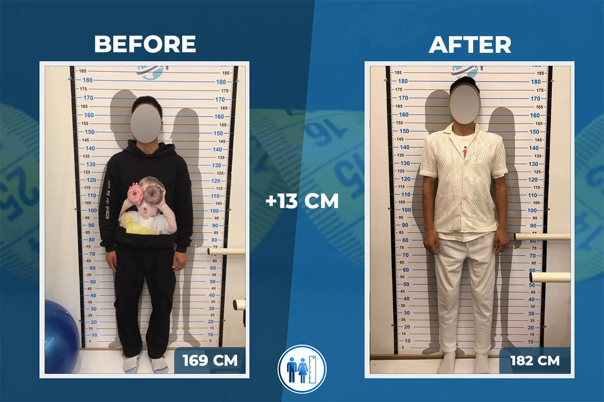 Body Proportions after Limb Lengthening Surgery